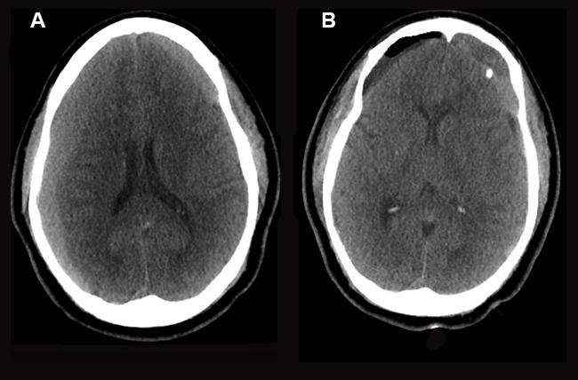 Subdural_hematoma_before_and_after_treatment